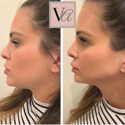 Jawline Contour Procedure