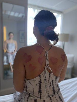 Cupping Therapy *Alleviate symptoms by promoting blood circulation and improving immunity while experiencing a deep tissue release