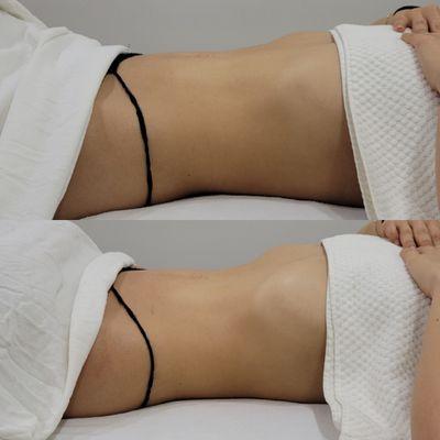 Brazilian Lymphatic Drainage first-time client results