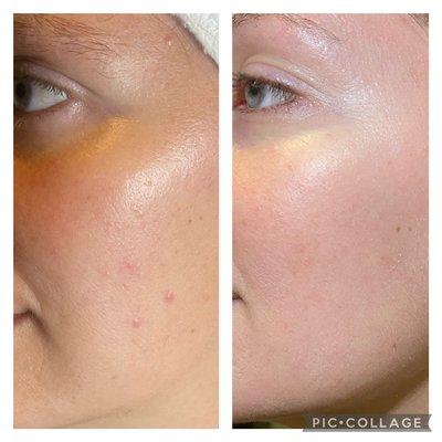 ProCell Microchanneling after 2 treatments.