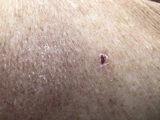 followup pic from burn, 2 weeks later