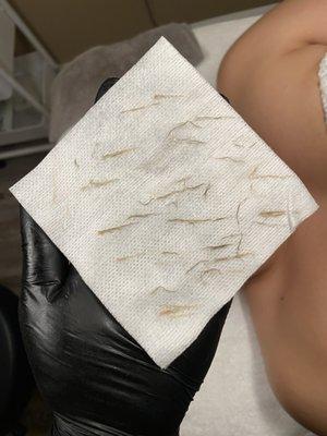 Dead skin and peach fuzz removed with dermaplaning