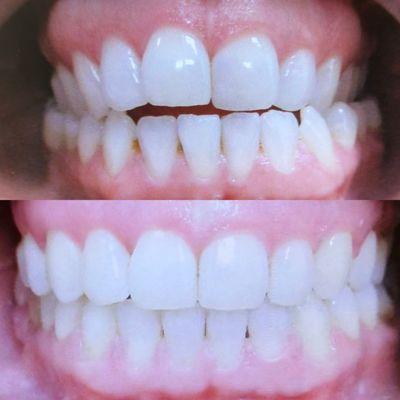 Before and after: Successful closure of an open bite and posterior crossbites, enhancing bite efficiency and overall smile harmony.