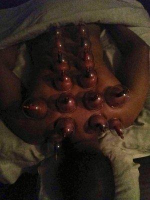 Me getting cupped! First experience and highly recommended!