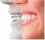 Invisalign® is the invisible way to straighten your teeth without braces.