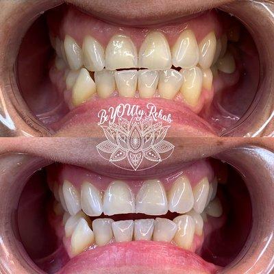 Teeth Whitening $99 Special month of April 2022