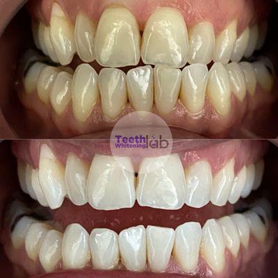 Teeth Whitening Lab