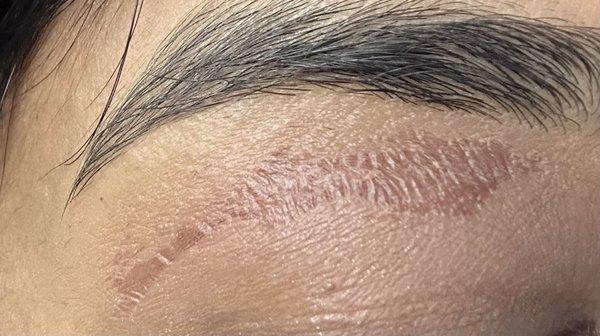 Burns under both brows after waxing