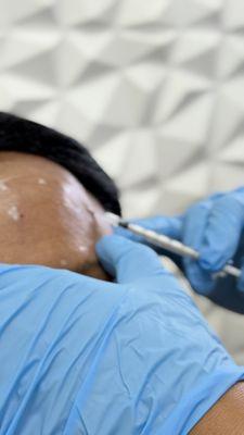 Wrinkle Relaxer treatment