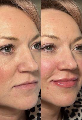Before & After Lip Filler. Natural looking results.