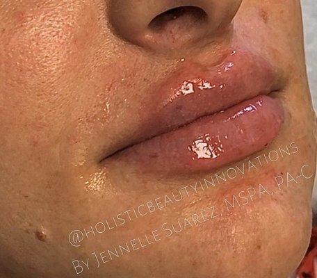 Beautiful set of lips achieved with one syringe of Restylane Kysse