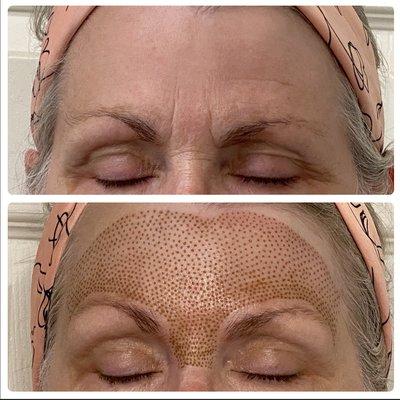 Fore head/ Brow lift