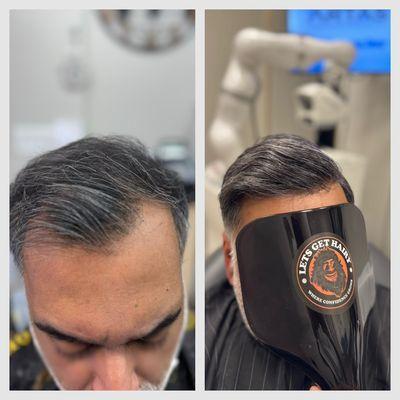 Non-surgical hair replacement (Hair System)