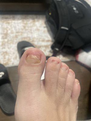 They gave me a fungus in my big toe and I have to go to the doctor! This is super nasty!