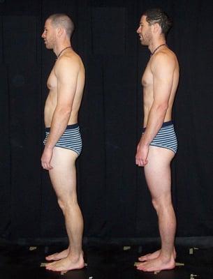 Before and after photo shows comparative changes in posture after 10 session Rolfing Series.