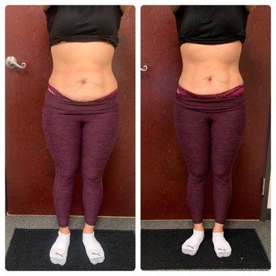 Body contouring-cavitation Radio frequency-skim tightening