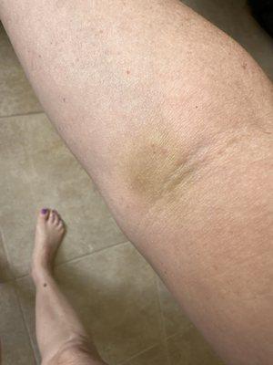 Day 6 after blood draw.