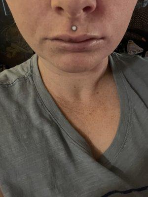 90% of the lip filler was injected in the middle of my upper lip leaving the rest unproportunate