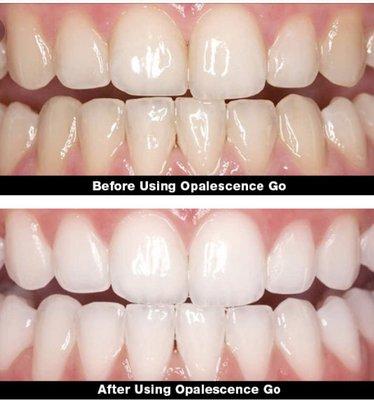 Professional whitening services are available in office, custom made take home trays or simply "to go!"