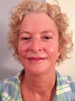 Radiofrequency firming treatment LED light treatment light peel light Microdermabrasion super hydration