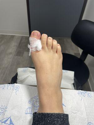 Ingrown in lots of pain. Very swollen. :(