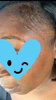 1. Day later bruised and additional blisters forming