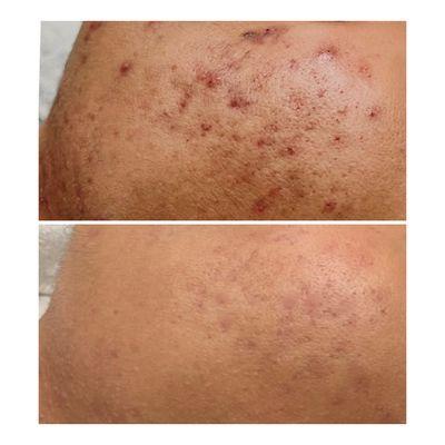 Acne leaves Hyperpigmentation. Before and after Five months apart.