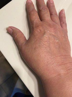 Swollen hand