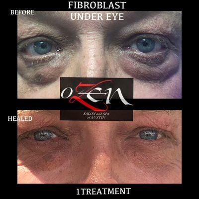 Fibroblast under eye