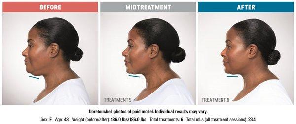 kybella before and after