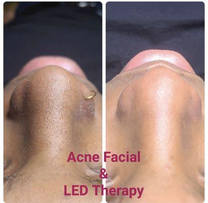 Acne & LED Therapy