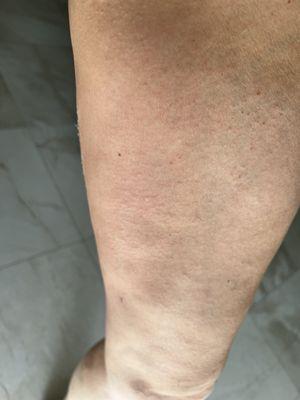 Palm Vascular Center Broward