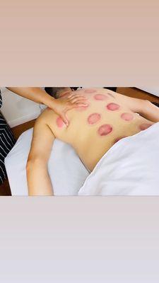 Cupping massage therapy