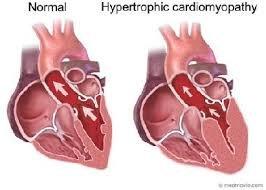 Hypertrophic Cardiomyopathy
