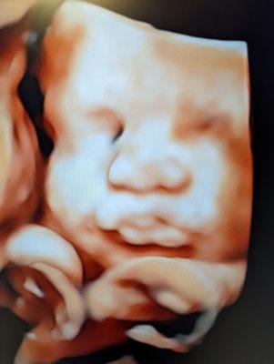 Castleton HD Ultrasound