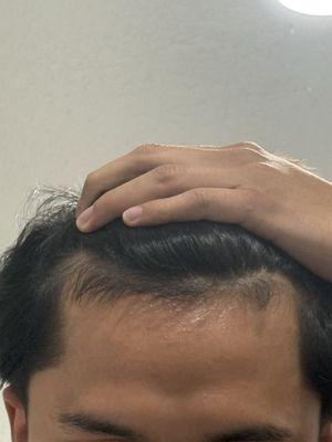 uneven hairline