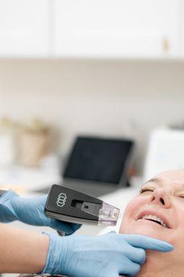 Morpheus8 Skin Tightening Treatment to decrease wrinkles, finalizes, and acne scarring while improving overall skin tone and texture.