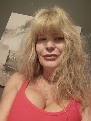 Less than week after sculptra, 1mo. out from Lazer!