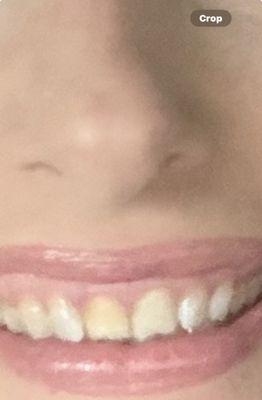 Before photo, dead tooth is discolored and pushed back.