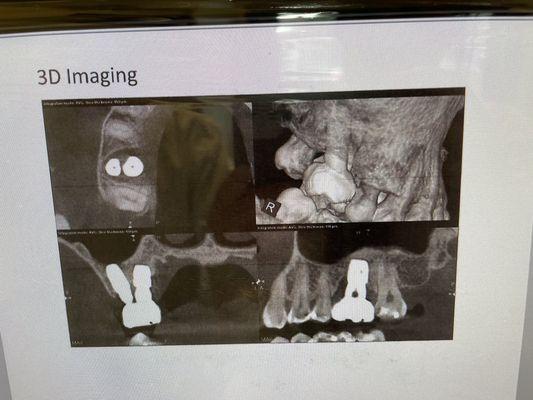 3D image of outdated implant type & bone loss