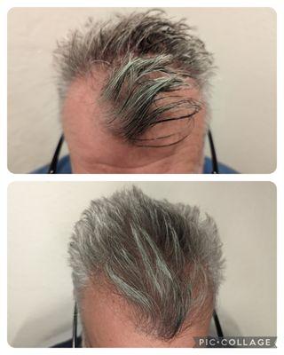 Hair restoration