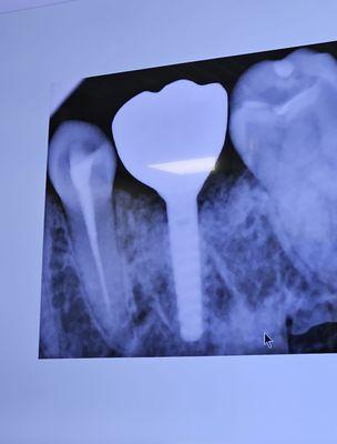 Implant after 3 years very minimal Bone loss