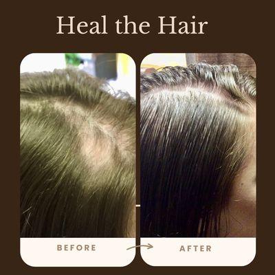This client has Alopecia Areata.
Hair loss can be confusing with so much information out there, we can help give you the guidance you need.