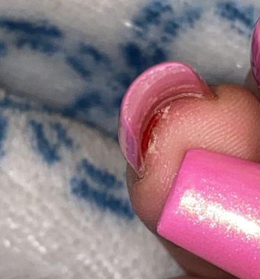 My painful and wounded nail bed I almost passed out when I felt/saw this