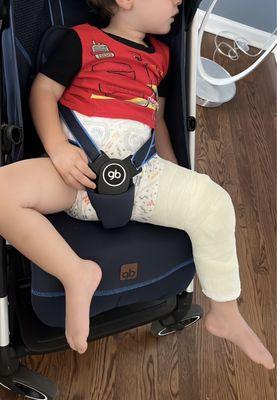 Full cast on leg Femur fracture