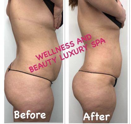 Body contouring, before and after pictures