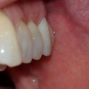 Crown on Molar