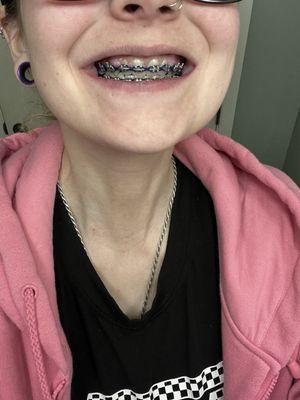 Braces after final adjustment