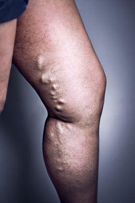 Advanced Varicose Vein Treatments of Manhattan