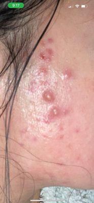 I came to her to treat my acne scar, which consultation made worse and gave me more acne